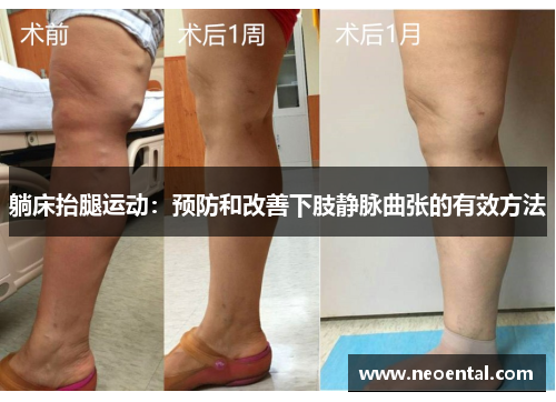 躺床抬腿运动：预防和改善下肢静脉曲张的有效方法